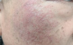 护肤品过敏有哪些症状？