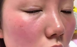 祛痘面膜敷后反长痘发红，为何？