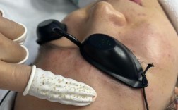 苗方清颜祛痘手法具体怎么操作？