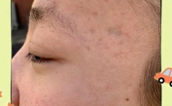 激光祛痘印会留痘坑吗？