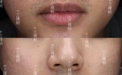 激光祛痘恢复期究竟多长？