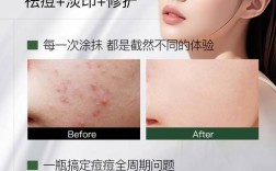 热水白糖祛痘印真有效吗？