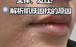 泽平祛痘会严重脱皮?