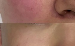 蓝光红光祛痘后皮肤干怎么办？