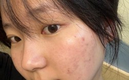 Olay prox祛痘印无效，是产品问题还是用法不对？