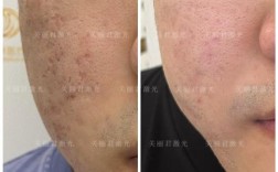 医院都能做激光祛痘吗？