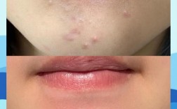 ddq祛痘是啥？效果真的好吗？