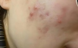 祛痘挤痘是美容院好选择吗？