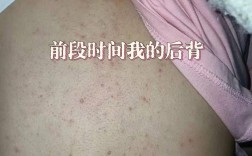 上海硫磺皂能祛背上痘痘吗？