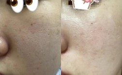 激光和点阵那个祛痘印