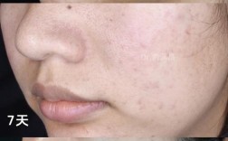 医院祛痘印效果真的好吗？