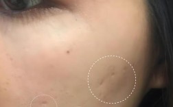 祛痘印痘坑凹洞视频真的能去吗？