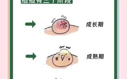 手挤痘安全吗？专业祛痘也需谨慎？