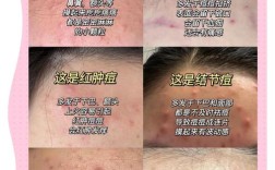 AHC祛痘效果到底怎么样？