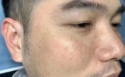 男生祛痘印斑，该咋选对方法？