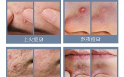 祛痘补水保湿美白痘印，怎么兼顾才有效？