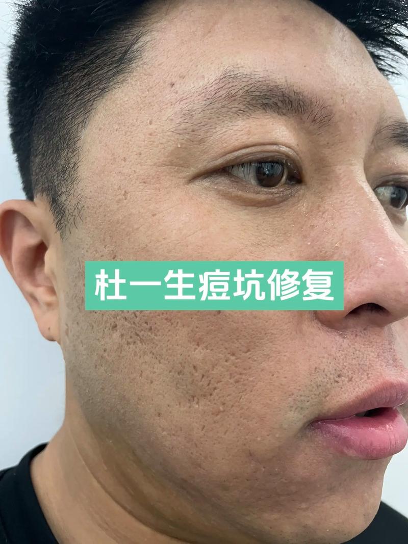 Biodermis祛痘疤效果真的好吗？-图2