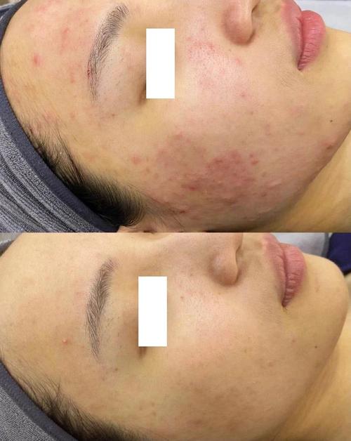 Vidivici祛痘效果真的好吗？-图2