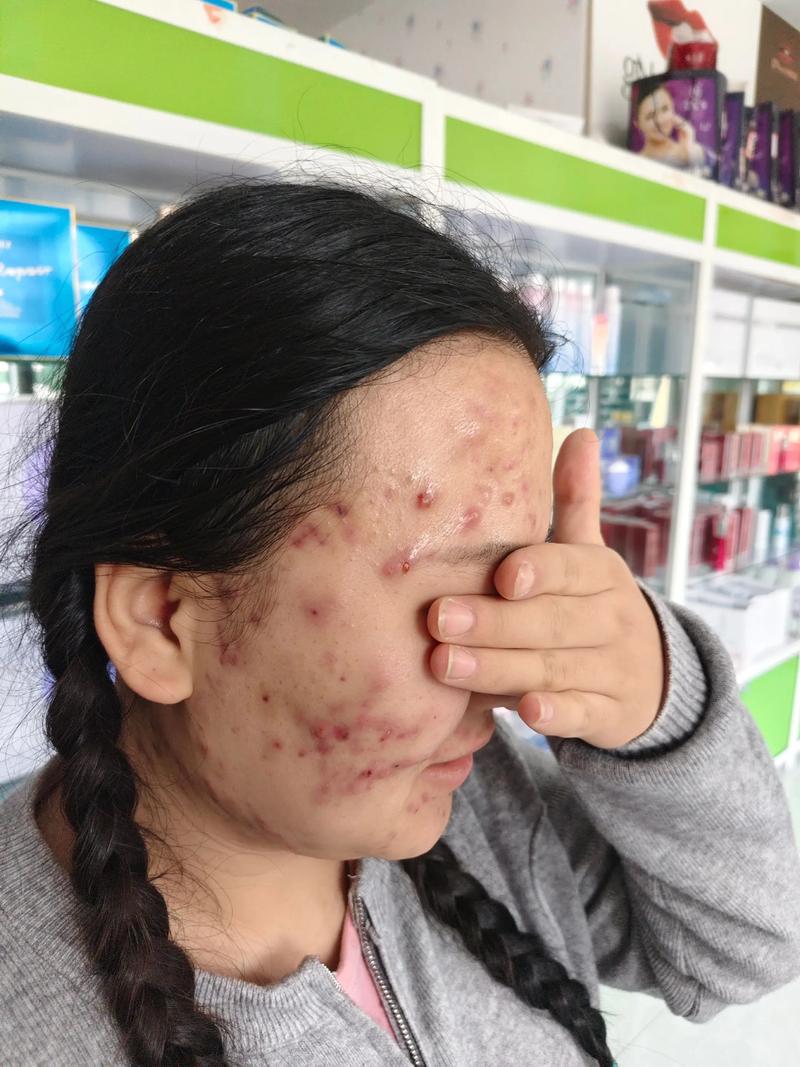 Clarisonic祛痘效果真的好吗?-图1 Clarisonic祛痘效果真的好吗?-图1