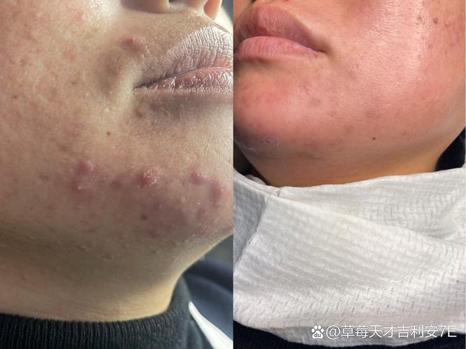 Olay prox祛痘印无效，是产品问题还是用法不对？-图2