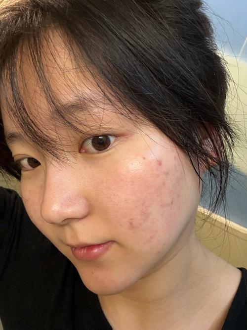 Olay prox祛痘印无效，是产品问题还是用法不对？-图1