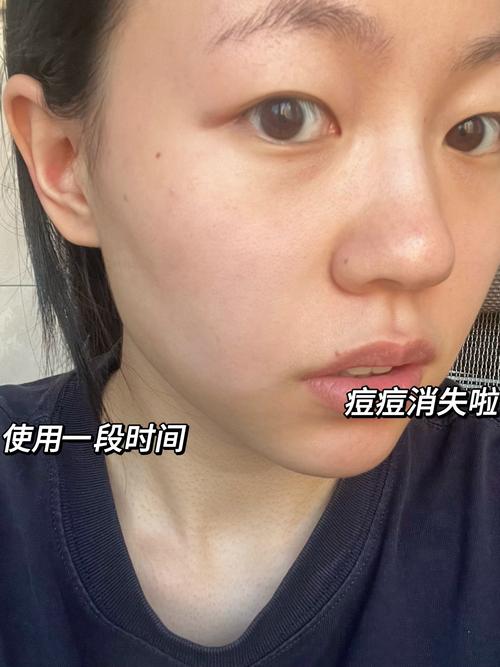 韩国stylenara祛痘真的有效吗？-图3