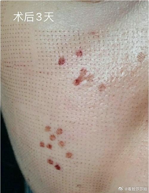 15岁可以做激光祛痘吗-图1