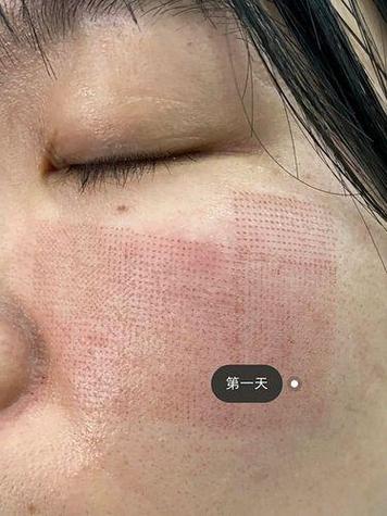 15岁可以做激光祛痘吗-图2