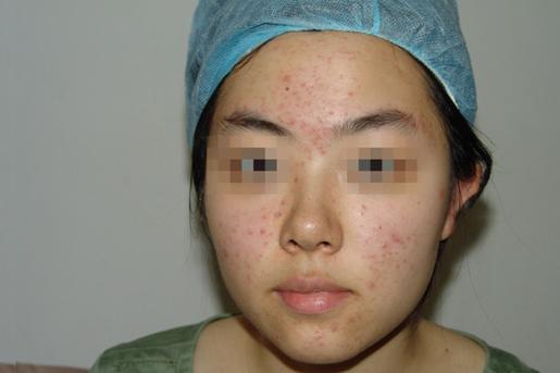 18岁去做激光祛痘好嘛-图2 18岁去做激光祛痘好嘛-图2
