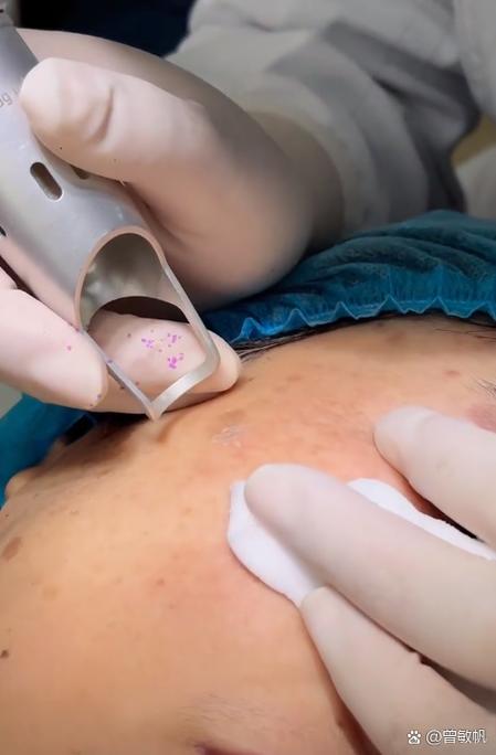 白糖祛痘具体怎么操作?-图2 白糖祛痘具体怎么操作?-图2