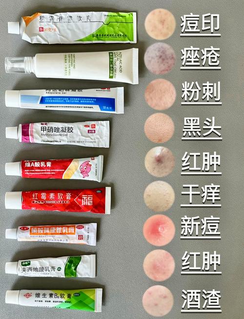 中州药膏祛痘效果是真的吗？-图3