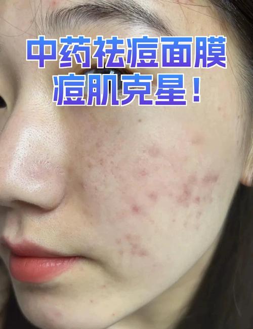 祛痘面膜用后到底要不要洗？-图2