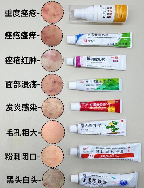 痘痘肌选护肤品，避开哪些成分更有效？-图1