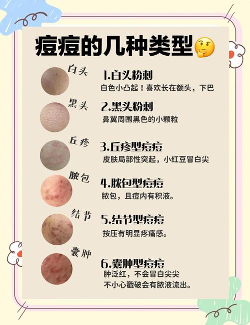 如何介绍自己的祛痘产品-图2