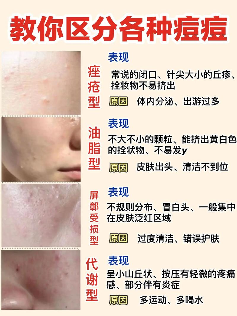 脸上痘痘怎么快速祛痘？-图2