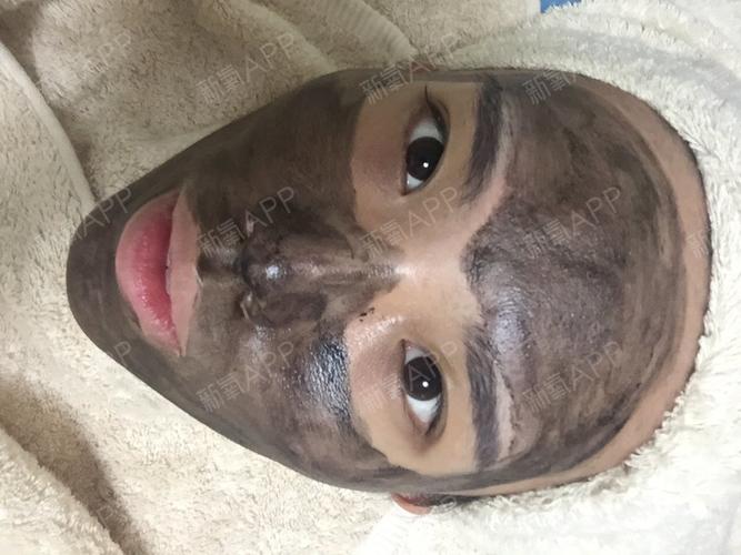 黑脸娃娃祛痘印效果真的好吗?-图1 黑脸娃娃祛痘印效果真的好吗?-图1