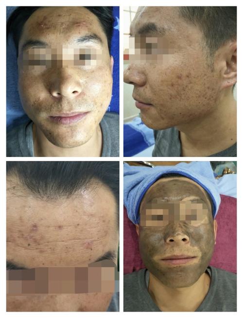 黑脸娃娃祛痘印效果真的好吗?-图2 黑脸娃娃祛痘印效果真的好吗?-图2