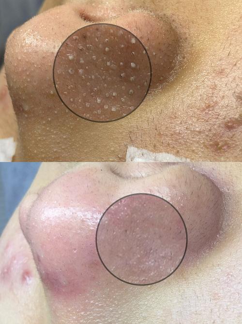 luna能祛痘去黑头吗-图1