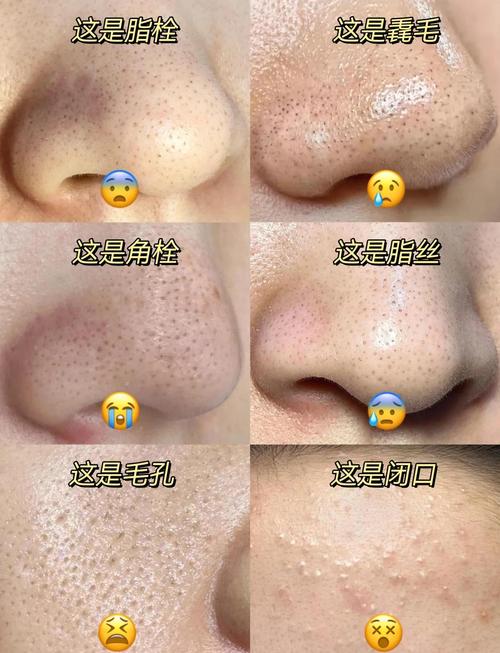 luna能祛痘去黑头吗-图3