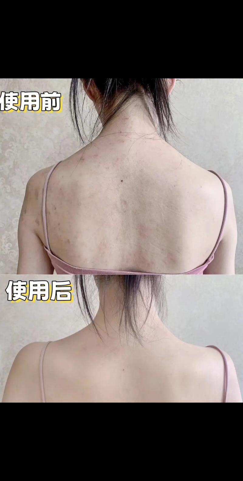 孕妇后背长痘怎么办？-图1