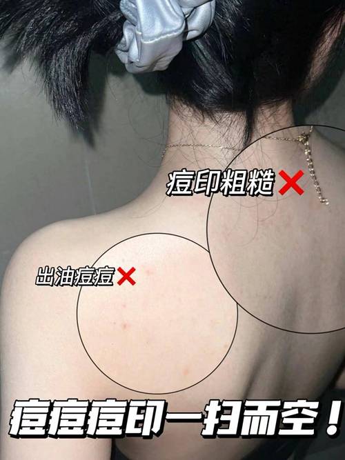 孕妇后背长痘怎么办？-图2