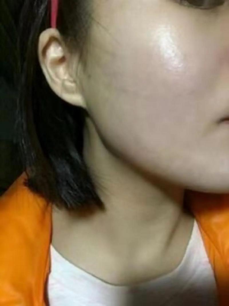 中药祛痘印效果真的好吗？-图3