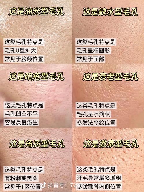 上海祛痘收缩毛孔，有效方法是什么？-图2