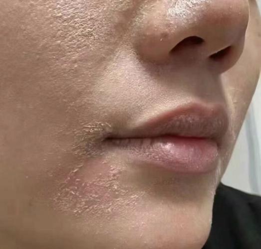 祛痘药致痘痘周围脱皮是何原因？-图2