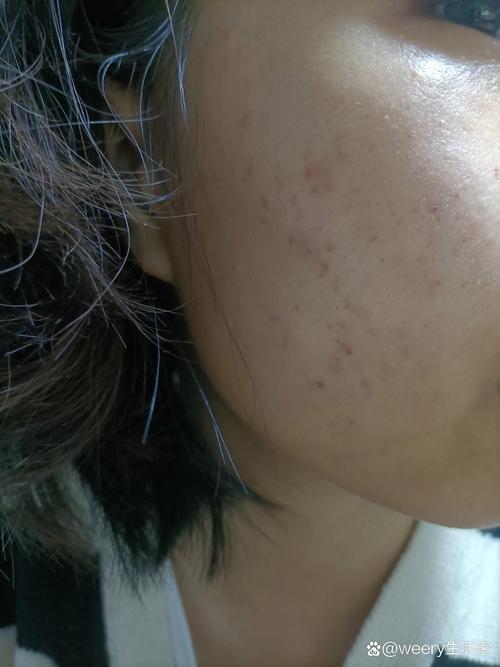 祛痘药致痘痘周围脱皮是何原因？-图1