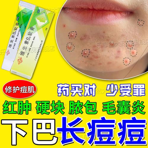 祛痘药致痘痘周围脱皮是何原因？-图3