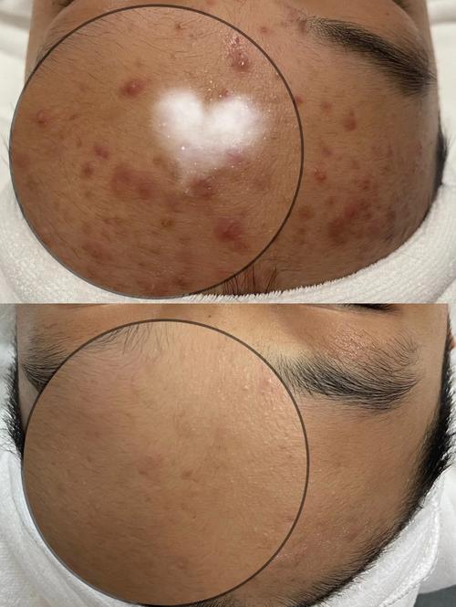 男士蜂毒祛痘净颜真的有效吗？-图1