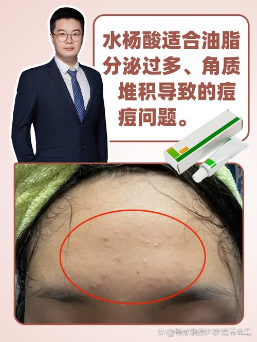 Luna Go能祛痘吗？-图3