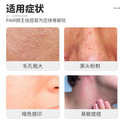 狮王祛痘膏 能去痘印吗-图3 狮王祛痘膏 能去痘印吗-图3
