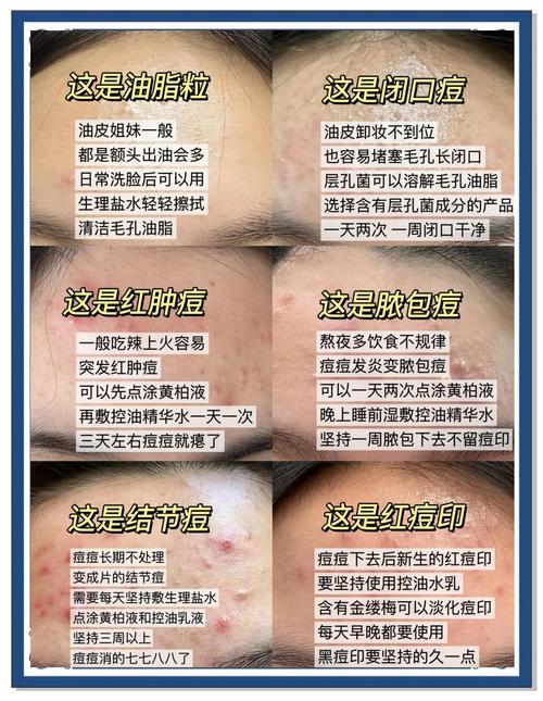 脑门长痘用什么祛痘最有效?-图1 脑门长痘用什么祛痘最有效?-图1